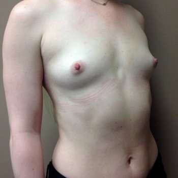 Breast Augmentation Before & After Patient #722