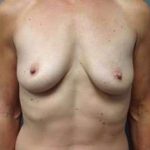 Breast Augmentation Before & After Patient #727