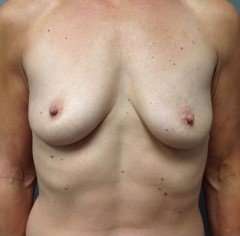 Breast Augmentation Before & After Patient #727