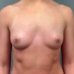 Breast Augmentation Before & After Patient #735