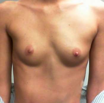 Breast Augmentation Before & After Patient #751