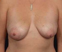 Breast Mastopexy Before & After Patient #126