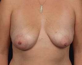 Breast Mastopexy Before & After Patient #126