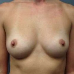 Breast Augmentation Before & After Patient #763