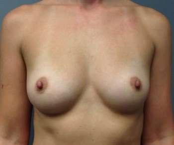 Breast Augmentation Before & After Patient #763
