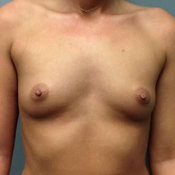 Breast Augmentation Before & After Patient #771