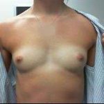 Breast Augmentation Before & After Patient #778