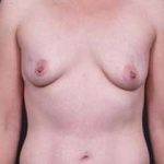 Breast Augmentation Before & After Patient #785