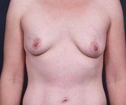Breast Augmentation Before & After Patient #785
