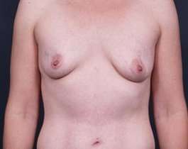Breast Augmentation Before & After Patient #785