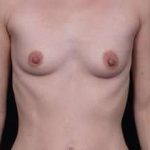 Breast Augmentation Before & After Patient #790