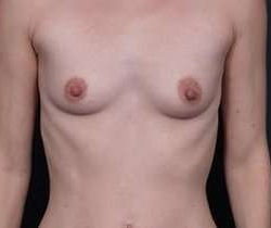 Breast Augmentation Before & After Patient #790