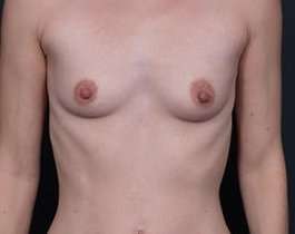 Breast Augmentation Before & After Patient #790