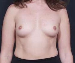 Breast Augmentation Before & After Patient #797
