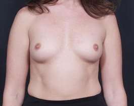 Breast Augmentation Before & After Patient #797