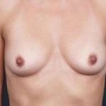 Breast Augmentation Before & After Patient #804