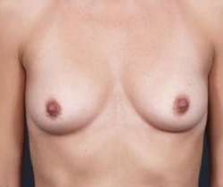 Breast Augmentation Before & After Patient #804