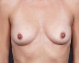 Breast Augmentation Before & After Patient #804