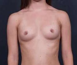 Breast Augmentation Before & After Patient #811