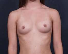 Breast Augmentation Before & After Patient #811