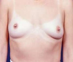 Breast Augmentation Before & After Patient #818