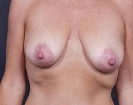Breast Mastopexy Before & After Patient #131