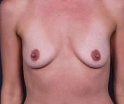 Breast Augmentation Before & After Patient #825