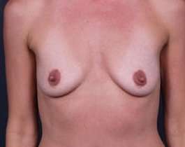 Breast Augmentation Before & After Patient #825