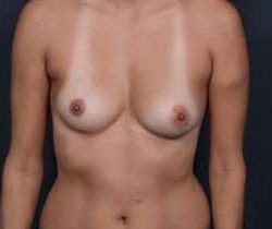 Breast Augmentation Before & After Patient #832