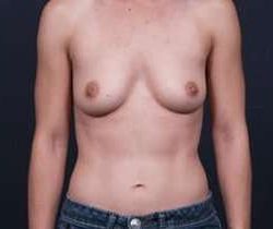 Breast Augmentation Before & After Patient #846