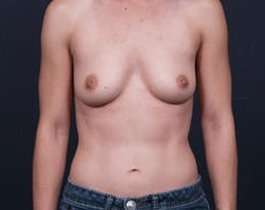 Breast Augmentation Before & After Patient #846