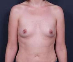 Breast Augmentation Before & After Patient #853