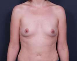 Breast Augmentation Before & After Patient #853