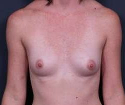 Breast Augmentation Before & After Patient #861
