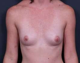 Breast Augmentation Before & After Patient #861