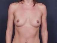 Breast Augmentation Before & After Patient #864