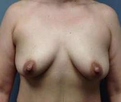 Breast Augmentation Before & After Patient #871
