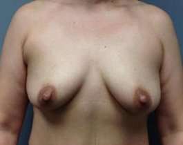 Breast Augmentation Before & After Patient #871