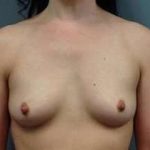 Breast Augmentation Before & After Patient #878