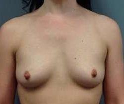 Breast Augmentation Before & After Patient #878