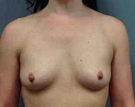 Breast Augmentation Before & After Patient #878
