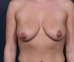 Breast Mastopexy Before & After Patient #136