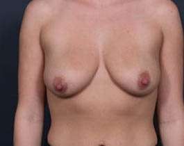 Breast Mastopexy Before & After Patient #136