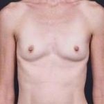 Breast Augmentation Before & After Patient #885
