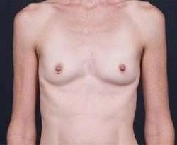Breast Augmentation Before & After Patient #885