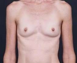 Breast Augmentation Before & After Patient #885