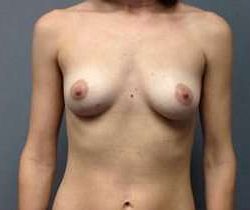 Breast Augmentation Before & After Patient #892