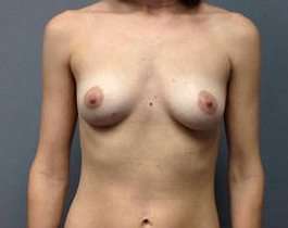 Breast Augmentation Before & After Patient #892
