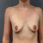 Breast Augmentation Before & After Patient #899