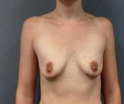Breast Augmentation Before & After Patient #899